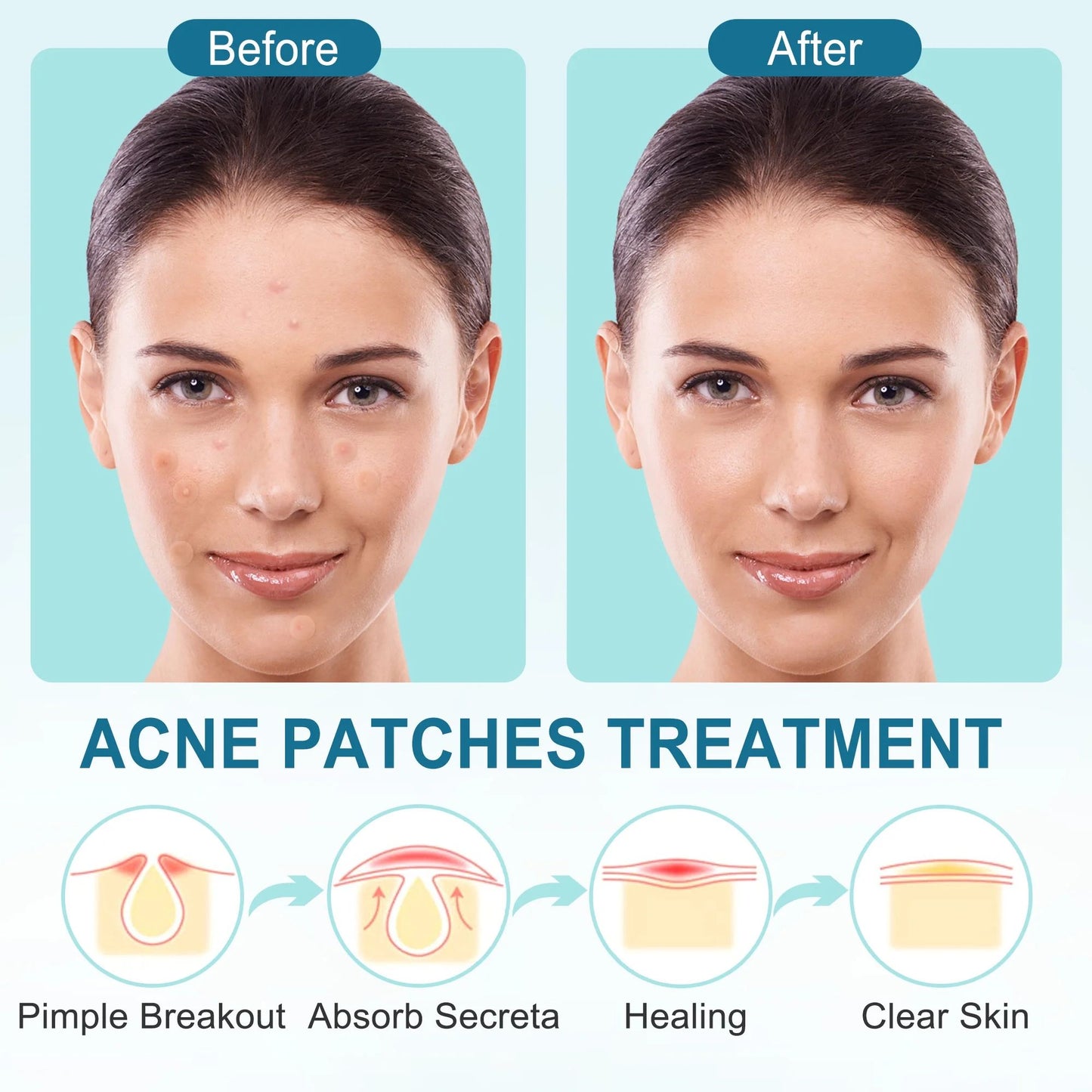 LotFancy 240 Ct Acne Spot Dots, Acne Pimple Patch, Thin Hydrocolloid Patches, 3 Sizes (12, 10, 8mm)