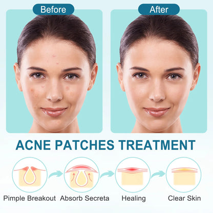 LotFancy 240 Ct Acne Spot Dots, Acne Pimple Patch, Thin Hydrocolloid Patches, 3 Sizes (12, 10, 8mm)